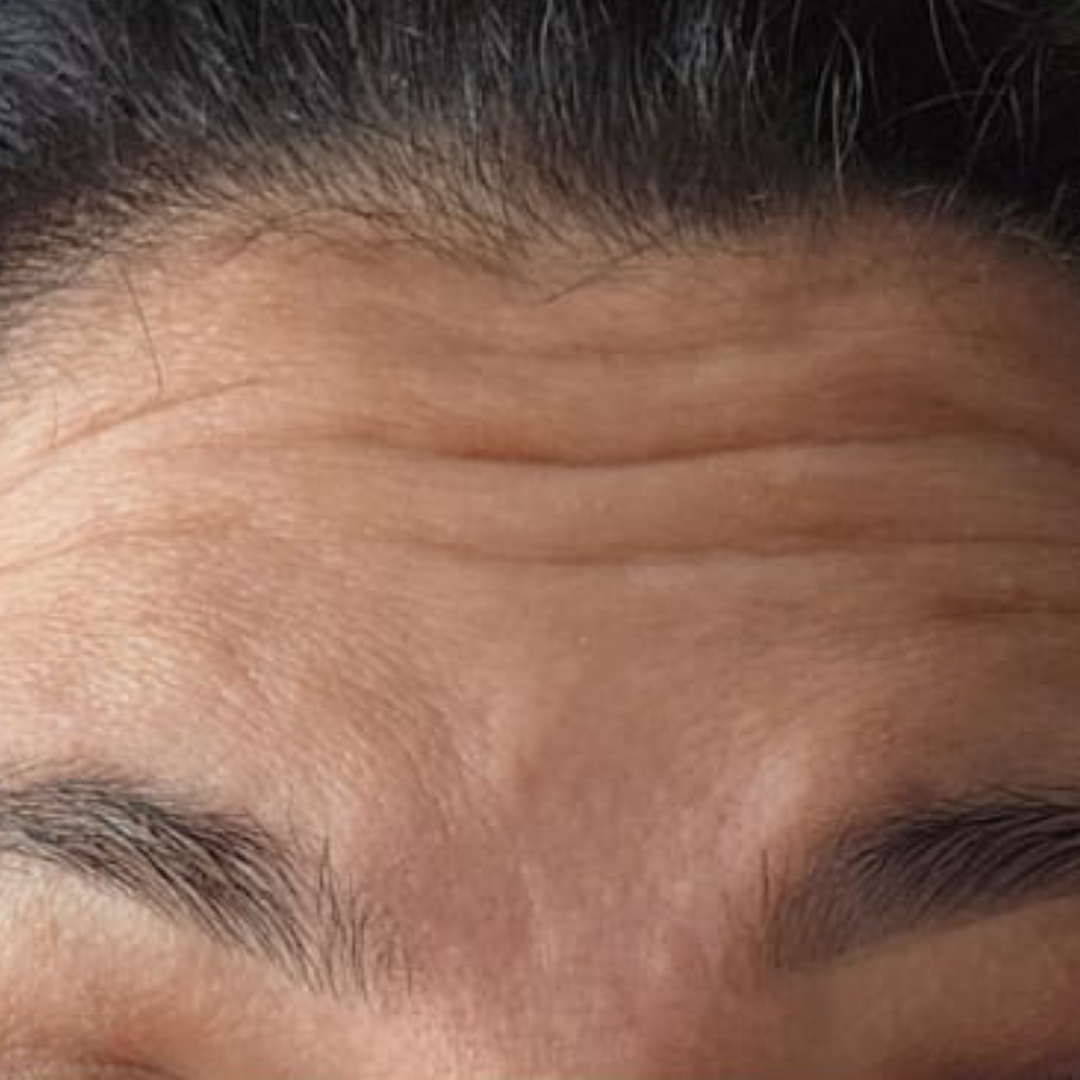 Antes_Botox Antes_Botox