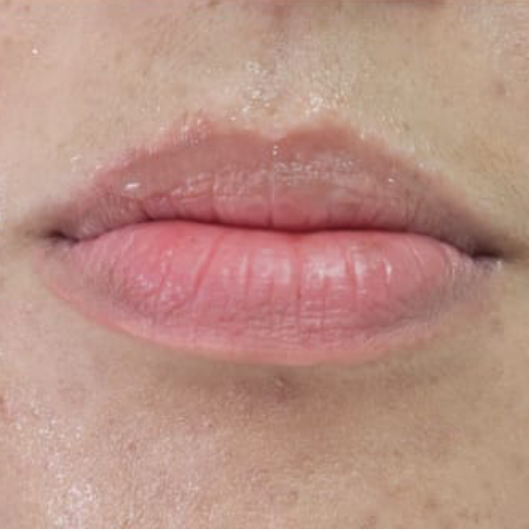 Antes_PreenchimentoLabial Antes_PreenchimentoLabial