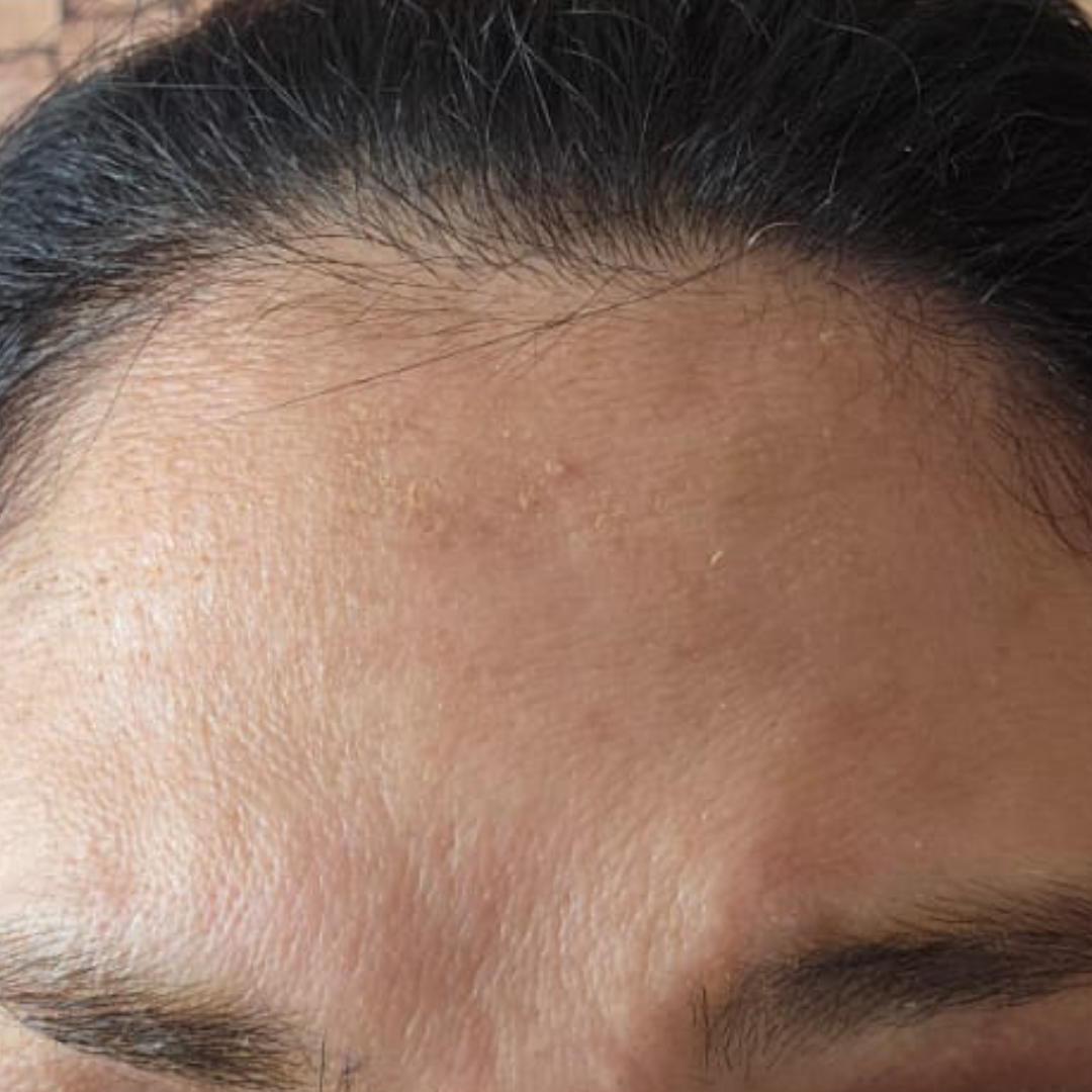 Depois_Botox Depois_Botox